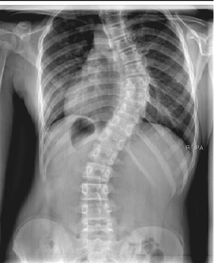 Scoliosis